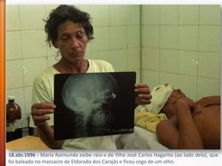 18.abr.1996 - Maria Raimunda exibe raio-x do filho José Carlos Hagarito (ao lado dela), que
foi baleado no massacre de Eldorado dos Carajás e ficou cego de um olho.
 