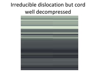 Irreducible dislocation but cord well decompressed 