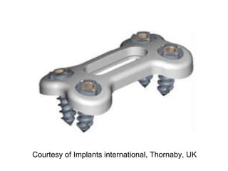 Courtesy of Implants international, Thornaby, UK 