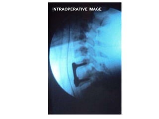 INTRAOPERATIVE IMAGE 
