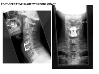 POST-OPERATIVE IMAGE WITH BONE GRAFT  