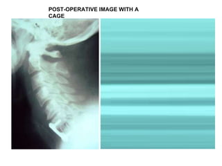 POST-OPERATIVE IMAGE WITH A CAGE  
