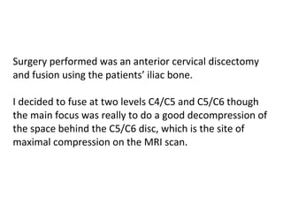 Surgery performed was an anterior cervical discectomy and fusion using the patients’ iliac bone.  I decided to fuse at two levels C4/C5 and C5/C6 though the main focus was really to do a good decompression of the space behind the C5/C6 disc, which is the site of maximal compression on the MRI scan.  