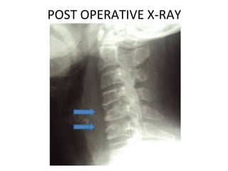 POST OPERATIVE X-RAY 