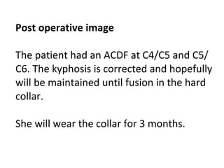 Post operative image The patient had an ACDF at C4/C5 and C5/C6. The kyphosis is corrected and hopefully will be maintained until fusion in the hard collar.  She will wear the collar for 3 months. 