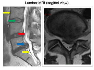 Lumbar MRI (sagittal view) 