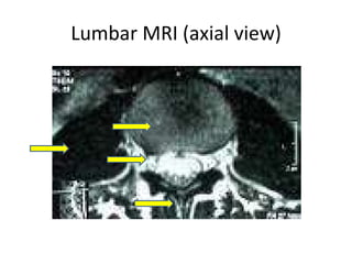 Lumbar MRI (axial view) 