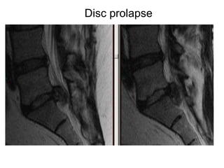 Disc prolapse 