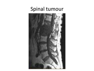 Spinal tumour 