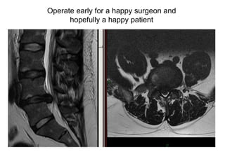 Operate early for a happy surgeon and hopefully a happy patient 