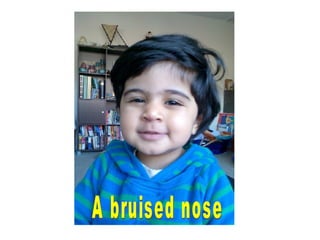 A bruised nose 