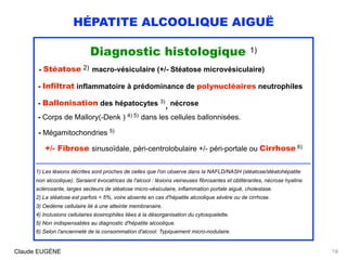 HÉPATITE ALCOOLIQUE AIGUË
Diagnostic histologique 1)
- Stéatose 2) macro-vésiculaire (+/- Stéatose microvésiculaire)
- Inf...