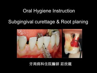 Oral Hygiene Instruction Subgingival curettage & Root planing  牙周病科住院醫師  莊欣龍 