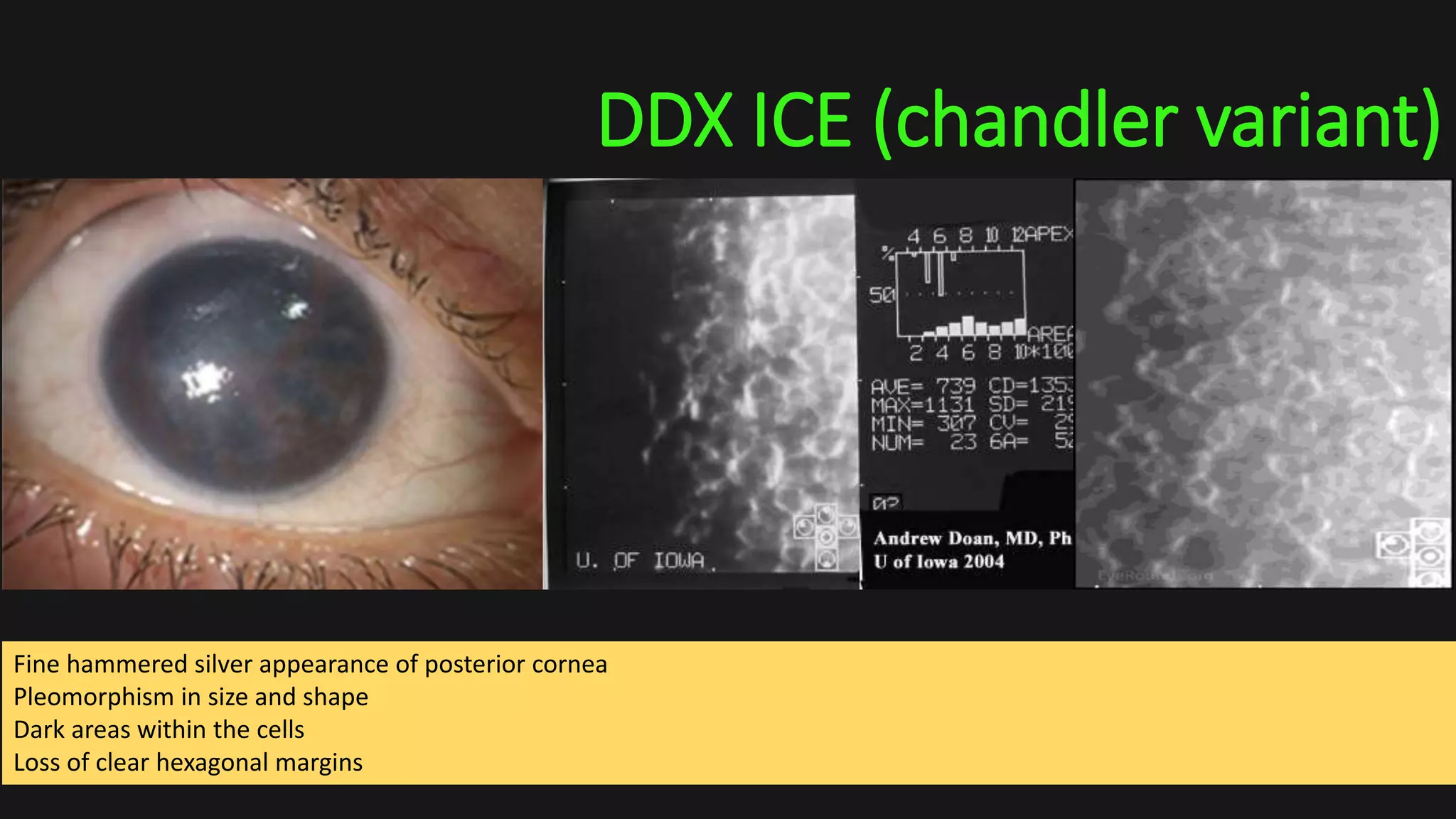 DDX ICE (chandler variant)
Fine hammered silver appearance of posterior cornea
Pleomorphism in size and shape
Dark areas within the cells
Loss of clear hexagonal margins
 