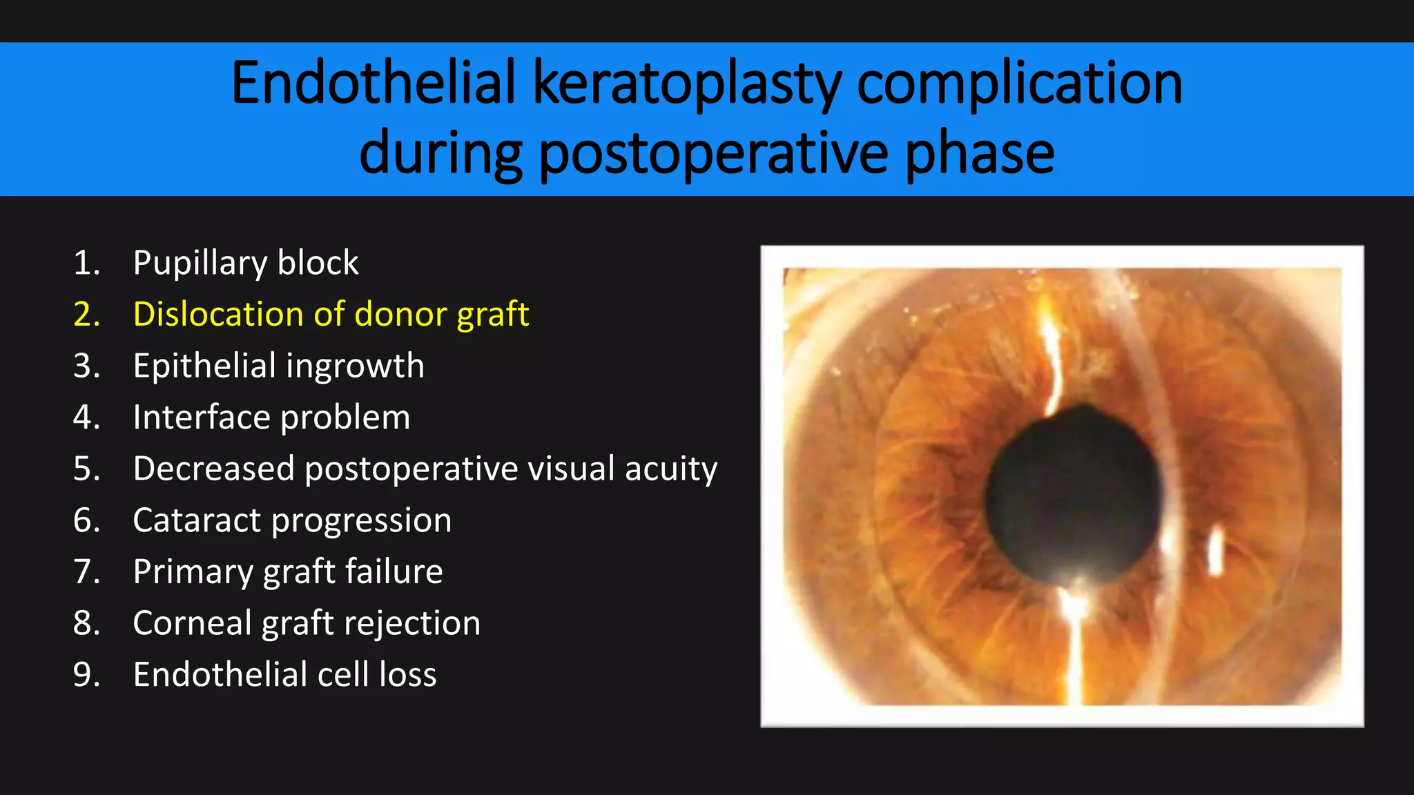 Endothelial keratoplasty complication
during postoperative phase
1. Pupillary block
2. Dislocation of donor graft
3. Epithelial ingrowth
4. Interface problem
5. Decreased postoperative visual acuity
6. Cataract progression
7. Primary graft failure
8. Corneal graft rejection
9. Endothelial cell loss
 