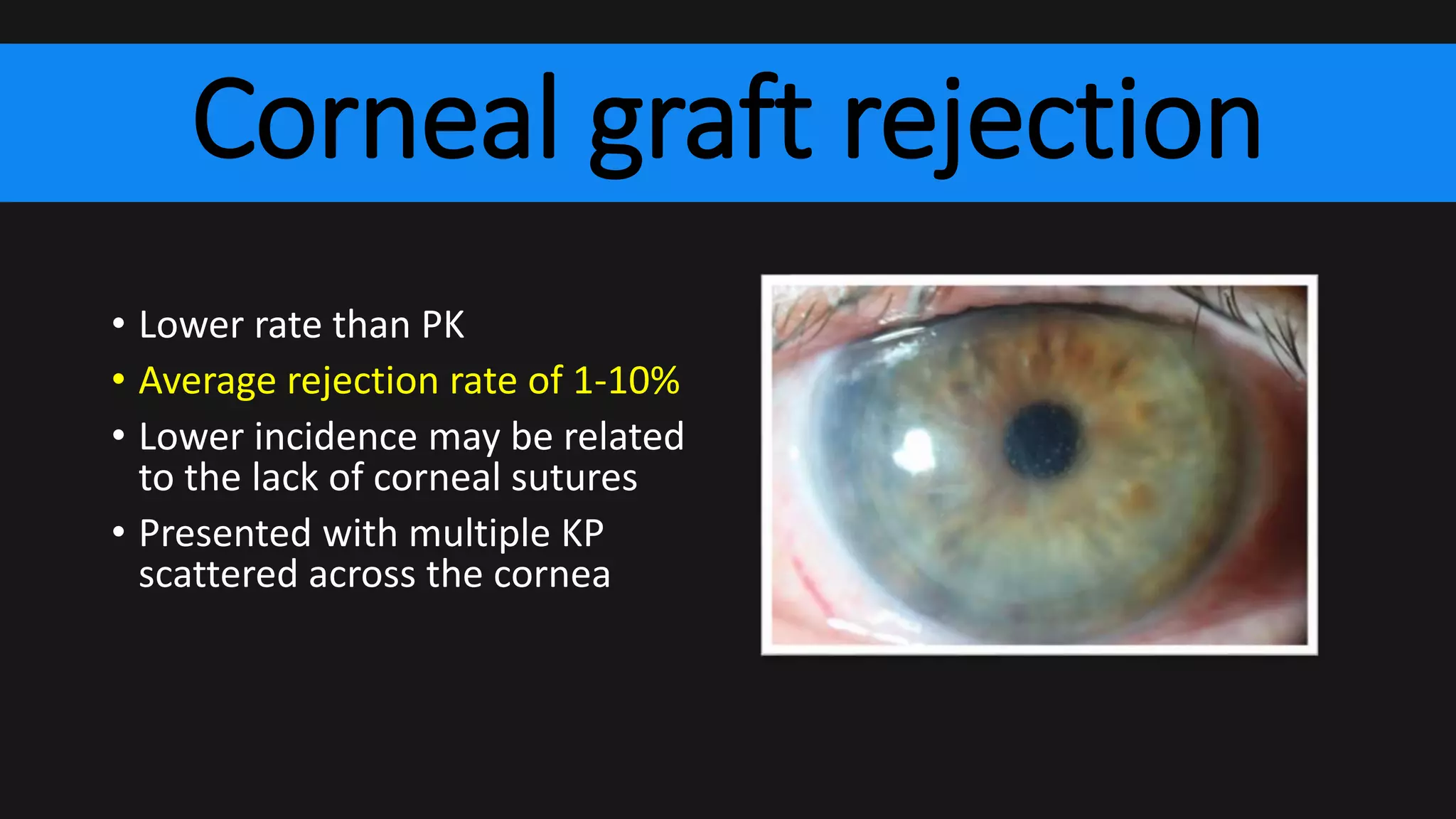 Corneal graft rejection
• Lower rate than PK
• Average rejection rate of 1-10%
• Lower incidence may be related
to the lack of corneal sutures
• Presented with multiple KP
scattered across the cornea
 