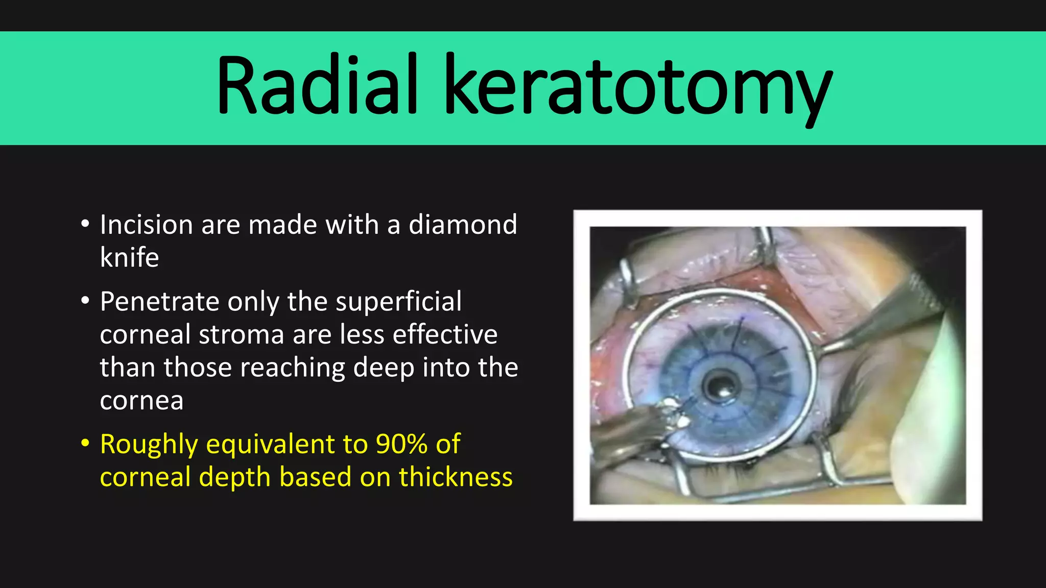 Radial keratotomy
• Incision are made with a diamond
knife
• Penetrate only the superficial
corneal stroma are less effective
than those reaching deep into the
cornea
• Roughly equivalent to 90% of
corneal depth based on thickness
 
