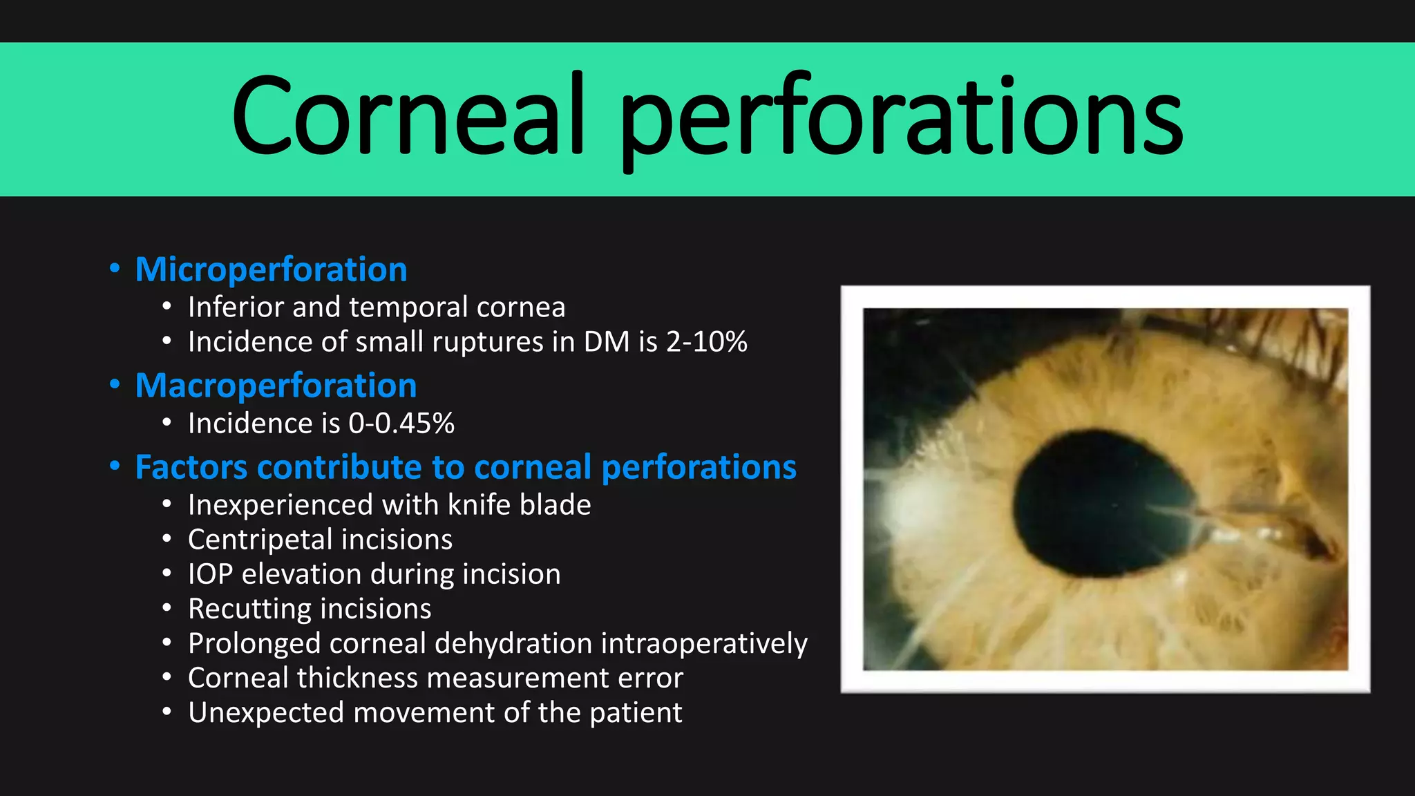 Corneal perforations
• Microperforation
• Inferior and temporal cornea
• Incidence of small ruptures in DM is 2-10%
• Macroperforation
• Incidence is 0-0.45%
• Factors contribute to corneal perforations
• Inexperienced with knife blade
• Centripetal incisions
• IOP elevation during incision
• Recutting incisions
• Prolonged corneal dehydration intraoperatively
• Corneal thickness measurement error
• Unexpected movement of the patient
 