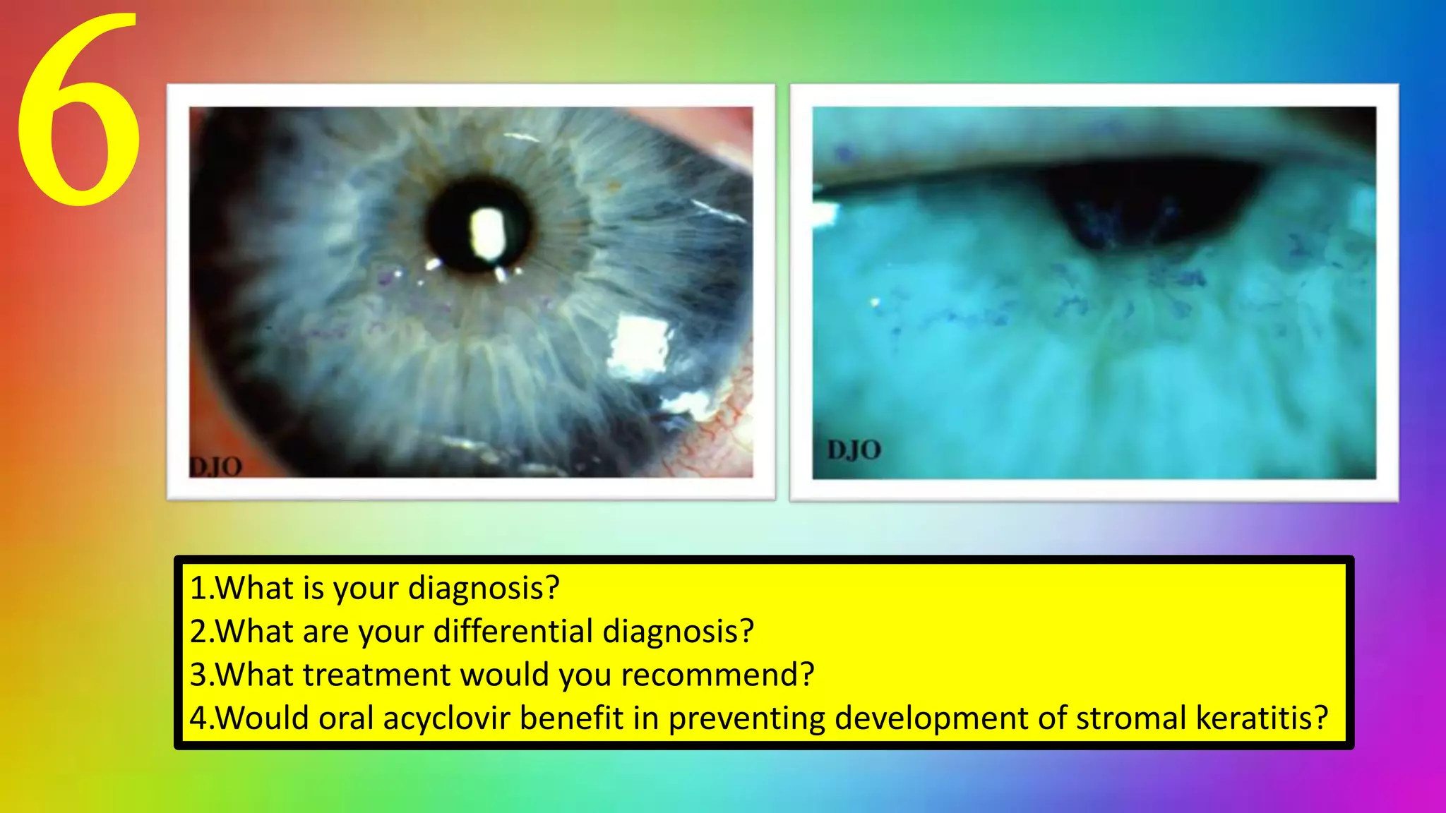 6
1.What is your diagnosis?
2.What are your differential diagnosis?
3.What treatment would you recommend?
4.Would oral acyclovir benefit in preventing development of stromal keratitis?
 
