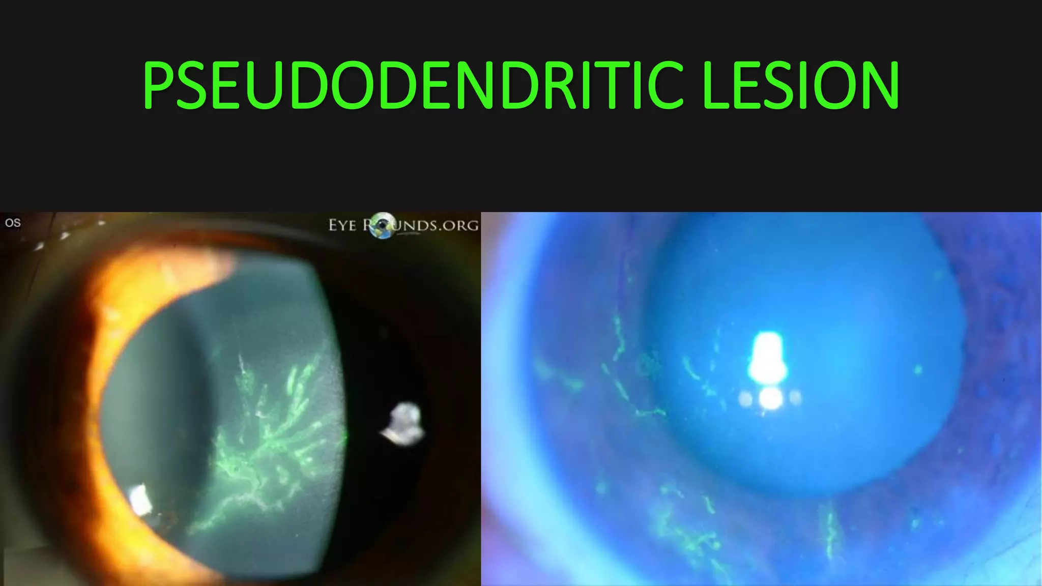 PSEUDODENDRITIC LESION
 