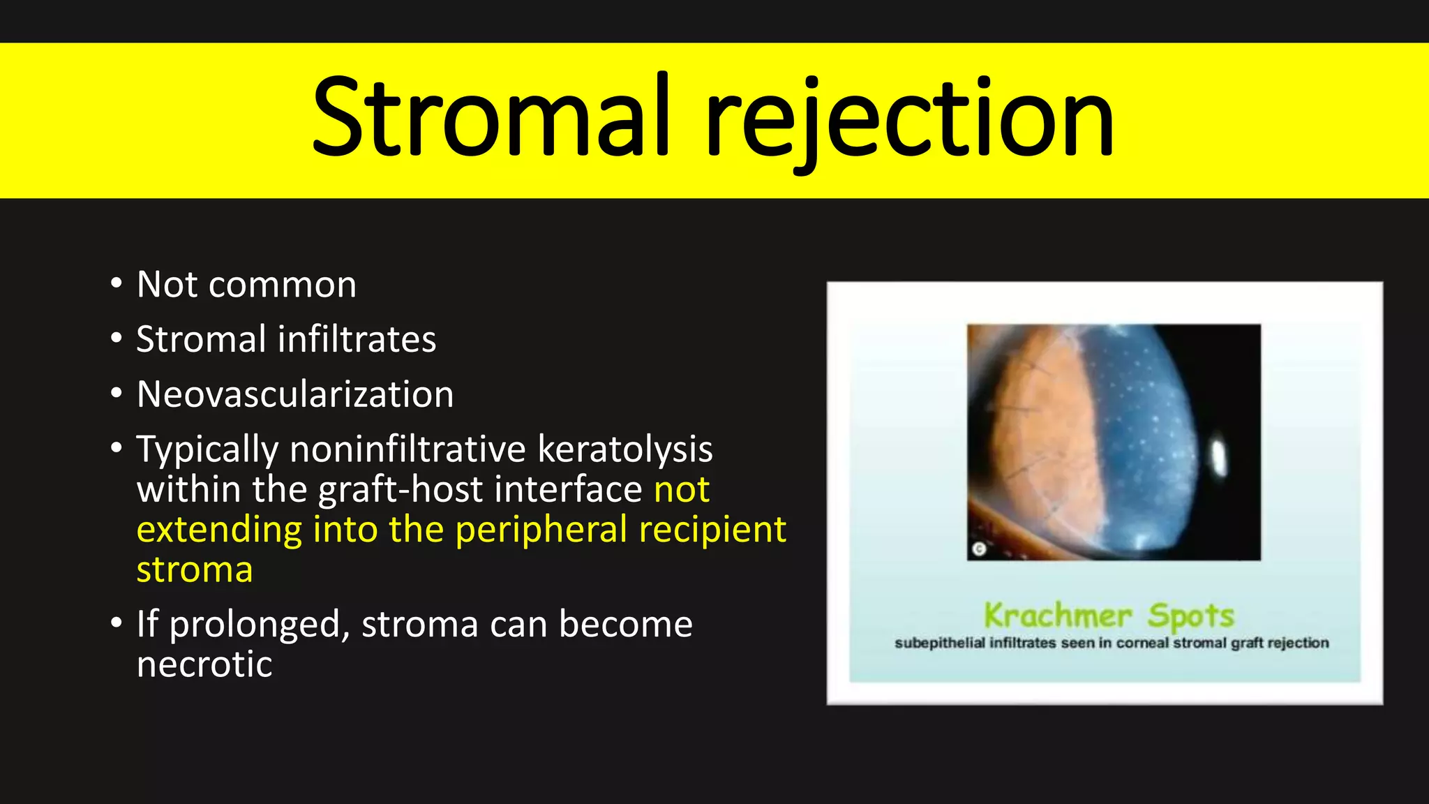 Stromal rejection
• Not common
• Stromal infiltrates
• Neovascularization
• Typically noninfiltrative keratolysis
within the graft-host interface not
extending into the peripheral recipient
stroma
• If prolonged, stroma can become
necrotic
 