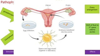 F
F
F
F
F F
F
F
F
F F
Stimulation Multiple follicles
VEGF
VEGF
VEGF
VEGF
VEGF
Bloodvessel
Ovary
enlargement
t
Production of
VEGF
Increase
permeability
Shift of fluid to
3rd space
edema
ascites
Effects
Risk
factors
Pathophysiology Endo hCG
Upregulate
F F
F F
F
F
F
Mature
Mature
Mature
Mature
Mature
VEGF
Mature
 
