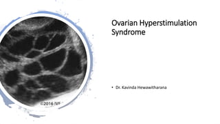 Ovarian Hyperstimulation
Syndrome
• Dr. Kavinda Hewawitharana
 