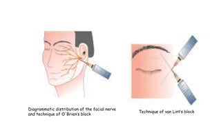 Technique of van Lint’s block
Diagrammatic distribution of the facial nerve
and technique of O'Brien’s block
 