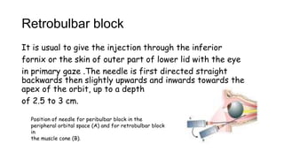 Retrobulbar block
It is usual to give the injection through the inferior
fornix or the skin of outer part of lower lid with the eye
in primary gaze .The needle is first directed straight
backwards then slightly upwards and inwards towards the
apex of the orbit, up to a depth
of 2.5 to 3 cm.
Position of needle for peribulbar block in the
peripheral orbital space (A) and for retrobulbar block
in
the muscle cone (B).
 