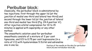 Peribulbar block:
Classically, the peribulbar block is administered by
two injections; first through the upper lid (at the
junction of medial one-third and lateral two-third) and
second through the lower lid (at the junction of lateral
one-third and medial two third (Fig. 24.4 position ‘A’).
After injection orbital compression for 10 to 15
minutes is applied with superpinky or any other
method.
The anaesthetic solution used for peribulbar
anaesthesia consists of a mixture of 2 per cent
lignocaine, and 0.5 to 0.75 per cent bupivacaine (in a
ratio of 2:1) with hyaluronidase 5 IU/ml and adrenaline
one in one lac. Position of the needle on the skin for peribulbar
block (A) and retrobulbar block (B).
 