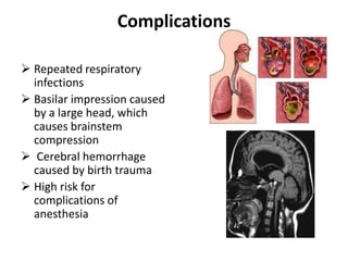 Complications

 Repeated respiratory
  infections
 Basilar impression caused
  by a large head, which
  causes brainstem
  compression
 Cerebral hemorrhage
  caused by birth trauma
 High risk for
  complications of
  anesthesia
 