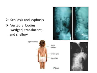  Scoliosis and kyphosis
 Vertebral bodies
 :wedged, translucent,
 and shallow
 