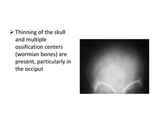  Thinning of the skull
  and multiple
  ossification centers
  (wormian bones) are
  present, particularly in
  the occiput
 