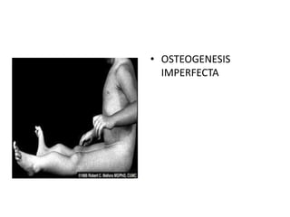 • OSTEOGENESIS
  IMPERFECTA
 