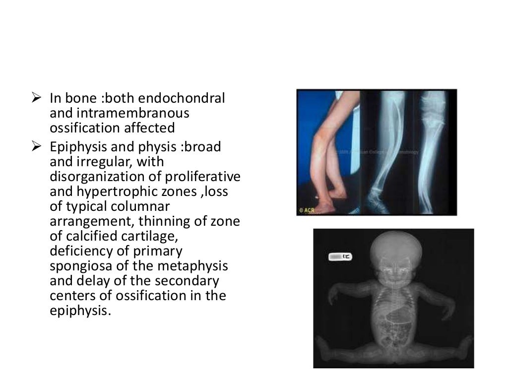 Osteogenesis Imperfecta Types