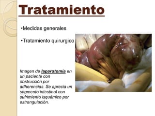 Tratamiento
•Medidas generales

•Tratamiento quirurgico




Imagen de laparotomía en
un paciente con
obstrucción por
adherencias. Se aprecia un
segmento intestinal con
sufrimiento isquémico por
estrangulación.
 
