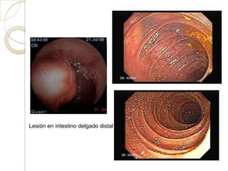 Lesión en intestino delgado distal
 