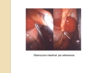 Obstruccìon intestinal por adherencia
 