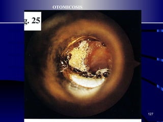 OTOMICOSIS 