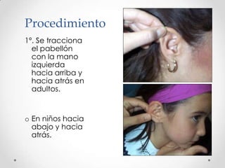Procedimiento
1º. Se tracciona
el pabellón
con la mano
izquierda
hacia arriba y
hacia atrás en
adultos.

o En niños hacia
abajo y hacia
atrás.

 