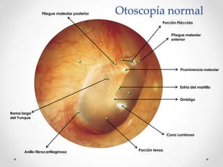 Pliegue maleolar posterior

Otoscopía normal
Porción Fláccida
Pliegue maleolar
anterior

Prominencia maleolar

Estría del martillo
Ombligo

Rama larga
del Yunque

Cono Luminoso

Anillo fibrocartilaginoso

Porción tensa

 