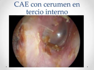 CAE con cerumen en
tercio interno

 