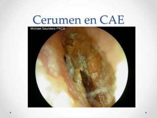 Cerumen en CAE

 