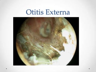 Otitis Externa

 