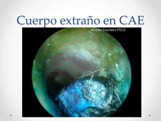 Cuerpo extraño en CAE

 