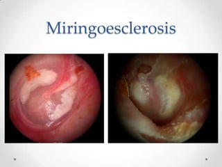 Miringoesclerosis

 