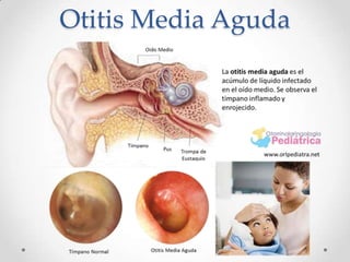 Otitis Media Aguda

 
