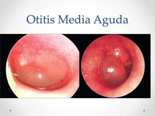 Otitis Media Aguda

 