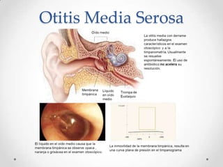Otitis Media Serosa

 
