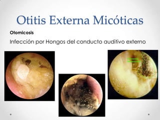 Otitis Externa Micóticas
Otomicosis

Infección por Hongos del conducto auditivo externo

 